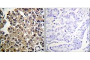 Immunohistochemistry analysis of paraffin-embedded human breast carcinoma tissue, using PDGFRB (Ab-1009) Antibody. (PDGFRB 抗体  (AA 981-1030))