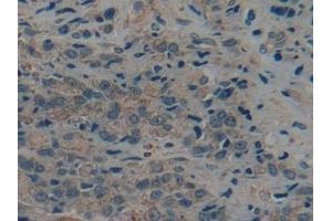Detection of CK9 in Human Prostate cancer Tissue using Polyclonal Antibody to Cytokeratin 9 (CK9) (KRT9 抗体  (AA 315-456))