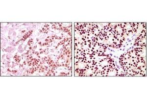 Immunohistochemical analysis of paraffin-embedded human breast carcinoma, using ER-alpha mouse mAb showing nuclear expression with DAB staining.