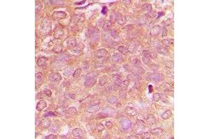 Immunohistochemical analysis of NBEAL1 staining in human breast cancer formalin fixed paraffin embedded tissue section. (NBEAL1 抗体)