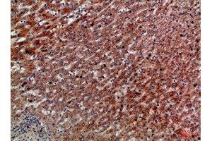 Immunohistochemical analysis of paraffin-embedded Human-liver-cancer, antibody was diluted at 1:100 (CXCR1 抗体  (AA 1-50))