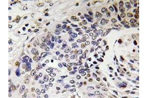 Immunohistochemistry analyzes of NF-H antibody in paraffin-embedded human lung carcinoma tissue. (NEFH 抗体)