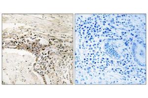 Immunohistochemistry analysis of paraffin-embedded human lung carcinoma tissue using SSH3 antibody. (SSH3 抗体  (Internal Region))
