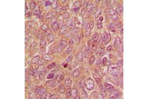 Immunohistochemical analysis of DUSP9 staining in human breast cancer formalin fixed paraffin embedded tissue section. (DUSP9 抗体)