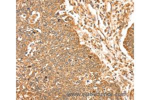 Immunohistochemistry of Human lung cancer using MAPK7 Polyclonal Antibody at dilution of 1:35 (MAPK7 抗体)