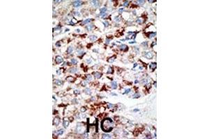 Formalin-fixed and paraffin-embedded human cancer tissue reacted with the primary antibody, which was peroxidase-conjugated to the secondary antibody, followed by DAB staining. (UBA3 抗体  (C-Term))