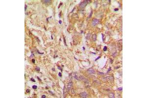 Immunohistochemical analysis of VEGFB staining in human breast cancer formalin fixed paraffin embedded tissue section. (VEGFB 抗体  (Center))