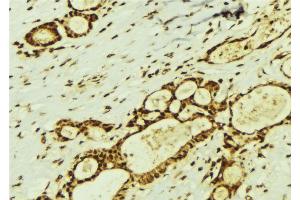 ABIN6274369 at 1/100 staining Human breast cancer tissue by IHC-P. (Translin 抗体  (Internal Region))