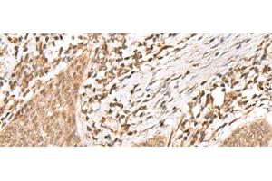 Immunohistochemistry of paraffin-embedded Human esophagus cancer tissue using KDM2A Polyclonal Antibody at dilution of 1:55(x200) (KDM2A 抗体)