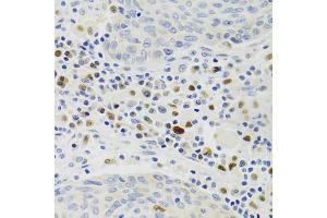 Immunohistochemistry of paraffin-embedded human lung cancer using GEMIN2 Antibody (ABIN1872798) at dilution of 1:100 (40x lens). (SIP1 抗体)