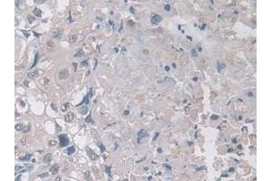 Detection of Ub in Human Lung cancer Tissue using Polyclonal Antibody to Ubiquitin (Ub) (Ubiquitin 抗体  (AA 1-229))