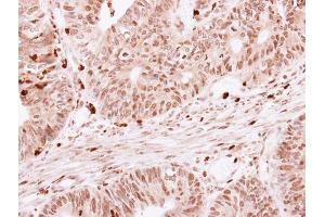IHC-P Image SKAP55 antibody detects SKAP1 protein at cytoplasm on human colon carcinoma by immunohistochemical analysis. (SKAP1 抗体)