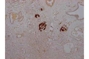 IHC image of ABIN7127574 diluted at 1:100 and staining in paraffin-embedded human pancreatic cancer performed on a Leica BondTM system. (Recombinant Insulin 抗体)