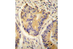 ADH4 antibody immunohistochemistry analysis in formalin fixed and paraffin embedded human colon carcinoma followed by peroxidase conjugation of the secondary antibody and DAB staining. (ADH4 抗体  (C-Term))