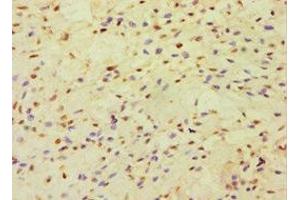 Immunohistochemistry of paraffin-embedded human breast cancer using ABIN7150999 at dilution of 1:100 (CBLC 抗体  (AA 245-474))