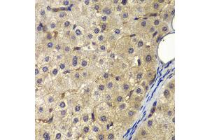 Immunohistochemistry of paraffin-embedded human liver cancer using AP2A2 antibody (ABIN6292468) at dilution of 1:200 (40x lens). (AP2A2 抗体)