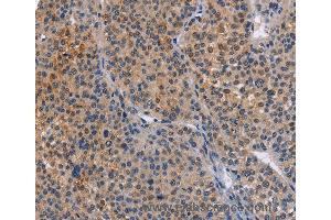 Immunohistochemistry of Human cervical cancer using MAP3K13 Polyclonal Antibody at dilution of 1:40