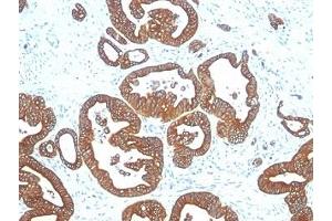 Formalin-fixed, paraffin-embedded human colon carcinoma stained with Cytokeratin 18 antibody (DE-K18). (Cytokeratin 18 抗体)