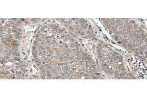 Immunohistochemistry of paraffin-embedded Human liver cancer tissue using UNC45B Polyclonal Antibody at dilution of 1:65(x200) (UNC45B 抗体)