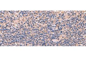 Immunohistochemistry of paraffin-embedded Human cervical cancer tissue using AHCYL1 Polyclonal Antibody at dilution of 1:70(x200) (AHCYL1 抗体)