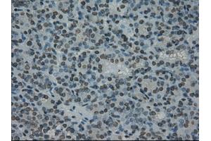 Immunohistochemical staining of paraffin-embedded Carcinoma of thyroid tissue using anti-PRKYmouse monoclonal antibody. (PRKY 抗体)