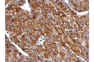 IHC-P Image Immunohistochemical analysis of paraffin-embedded U87 xenograft, using BIN1, antibody at 1:500 dilution. (BIN1 抗体)