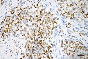 Immunohistochemistry was performed on paraffin-embedded human breast carcinoma using RBBP4 antibody (ABIN7800185), 1:200). (Recombinant Retinoblastoma Binding Protein 4 抗体)