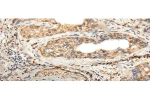 Immunohistochemistry of paraffin-embedded Human cervical cancer tissue using ZNF8 Polyclonal Antibody at dilution of 1:40(x200) (ZNF8 抗体)