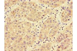 Immunohistochemistry of paraffin-embedded human liver cancer using ABIN7159112 at dilution of 1:100 (MED17 抗体  (AA 411-651))