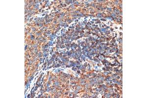 Immunohistochemistry of paraffin-embedded human esophageal cancer using FIP200 Rabbit pAb (ABIN7269881) at dilution of 1:100 (40x lens). (FIP200 抗体  (C-Term))