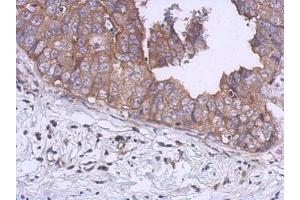 IHC-P Image Immunohistochemical analysis of paraffin-embedded human breast cancer, using UKHC, antibody at 1:500 dilution.