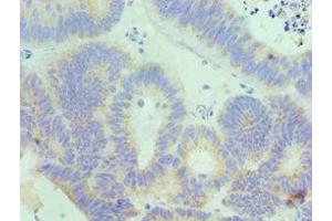 Immunohistochemistry of paraffin-embedded human colon cancer using ABIN7156833 at dilution of 1:100 (IL18RAP 抗体  (AA 390-599))