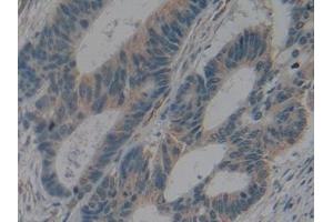 Detection of IL2Ra in Human Colorectal cancer Tissue using Polyclonal Antibody to Interleukin 2 Receptor Alpha (IL2Ra) (CD25 抗体  (AA 22-213))