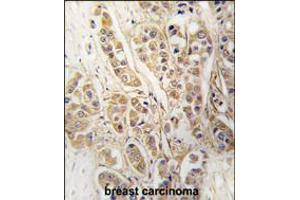 Formalin-fixed and paraffin-embedded human breast carcinoma tissue reacted with CLIC4 antibody , which was peroxidase-conjugated to the secondary antibody, followed by DAB staining. (CLIC4 抗体)
