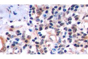 Detection of FAS in Human Endometrial cancer Tissue using Polyclonal Antibody to Factor Related Apoptosis (FAS) (FAS 抗体  (AA 22-172))