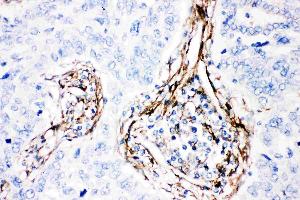 Anti-  Caveolin-1 picoband antibody, IHC(P): Human Lung Cancer Tissue (Caveolin-1 抗体  (AA 4-178))