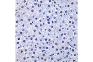Immunohistochemistry of paraffin-embedded human liver cancer using GSTP1 antibody. (GSTP1 抗体  (AA 1-210))