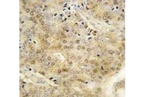IHC analysis of FFPE human prostate carcinoma tissue stained with EZH1 antibody