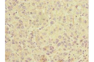 Immunohistochemistry of paraffin-embedded human liver cancer using ABIN7170191 at dilution of 1:100 (SLC25A36 抗体  (AA 58-110))