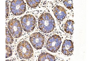 ABIN6265080 and ABIN6268997 at 1/100 staining Human colorectal cancer and adjacent normal tissues by IHC-P. (SIAH2 抗体  (C-Term))