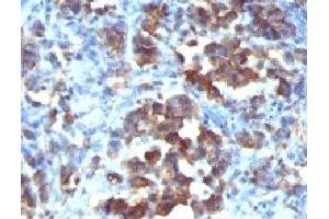 Formalin-fixed, paraffin-embedded human gastric carcinoma stained with Cdc20 antibody (CDC20/1102) (CDC20 抗体)