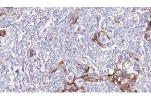 ABIN6277587 at 1/100 staining Human urothelial cancer tissue by IHC-P. (MERTK 抗体  (Internal Region))