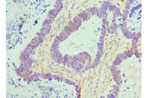 Immunohistochemistry of paraffin-embedded human ovarian cancer using ABIN7172779 at dilution of 1:100 (CTCF 抗体  (AA 1-260))