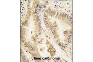 Formalin-fixed and paraffin-embedded human lung carcinoma tissue reacted with SOD2 Monoclonal Antibody (ABIN387807 and ABIN2843901) , which was peroxidase-conjugated to the secondary antibody, followed by DAB staining. (SOD2 抗体)