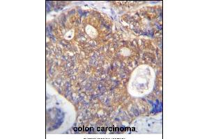 ICS Antibody (N-term) (ABIN656869 and ABIN2846073) immunohistochemistry analysis in formalin fixed and raffin embedded human colon carcinoma followed by peroxidase conjugation of the secondary antibody and DAB staining. (PAICS 抗体  (N-Term))