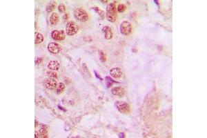 Immunohistochemical analysis of hnRNP A1 staining in human lung cancer formalin fixed paraffin embedded tissue section. (HNRNPA1 抗体  (Center))