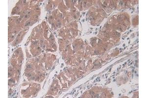 DAB staining on IHC-P; Samples: Human Glioma Tissue) (PAI1 抗体  (AA 25-402))
