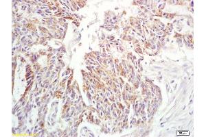Formalin-fixed and paraffin embedded human rectal carcinoma labeled with Anti-IL-6 Polyclonal Antibody, Unconjugated (ABIN872547) at 1:200 followed by conjugation to the secondary antibody and DAB staining