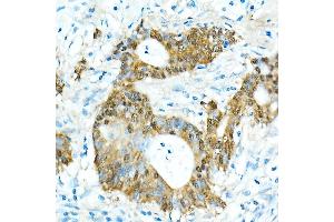 Immunohistochemistry of paraffin-embedded Human colon carcinoma using CDX2 antibody  at dilution of 1:300 (40x lens). (CDX2 抗体)