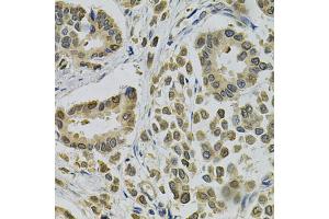 Immunohistochemistry of paraffin-embedded human breast cancer using EBAG9 Antibody (ABIN1872406) at dilution of 1:100 (40x lens). (RCAS1 抗体)